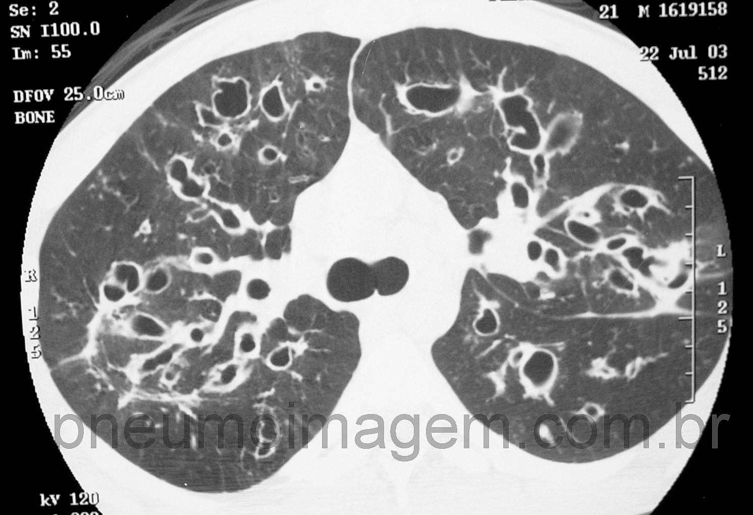DIRETRIZES BRASILEIRAS DE DIAGN�STICO E TRATAMENTO DA FIBROSE C�STICA: FA�A O DOWNLOAD